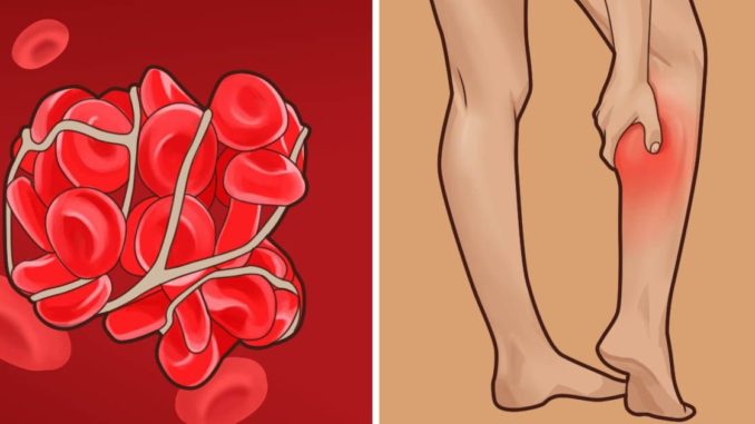 8 varovných příznaků krevních sraženin, které se nevyplácí ignorovat