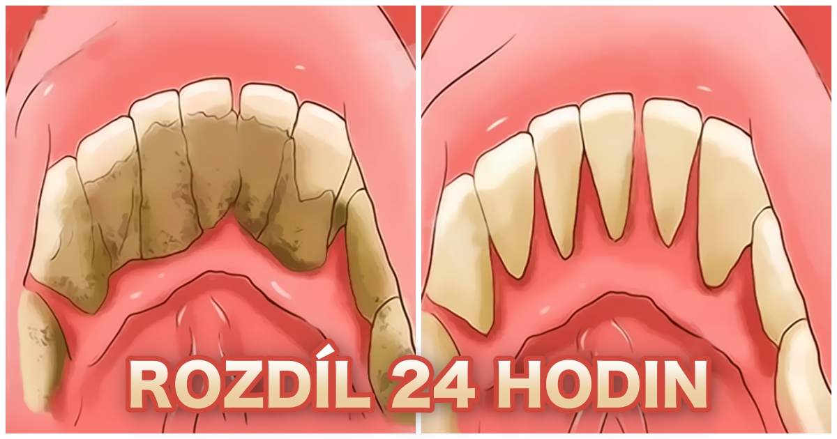 Co odstraní zubní kámen?