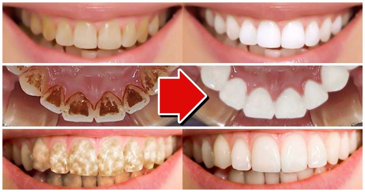 Jak vybělit zuby pomocí jedlé sody?