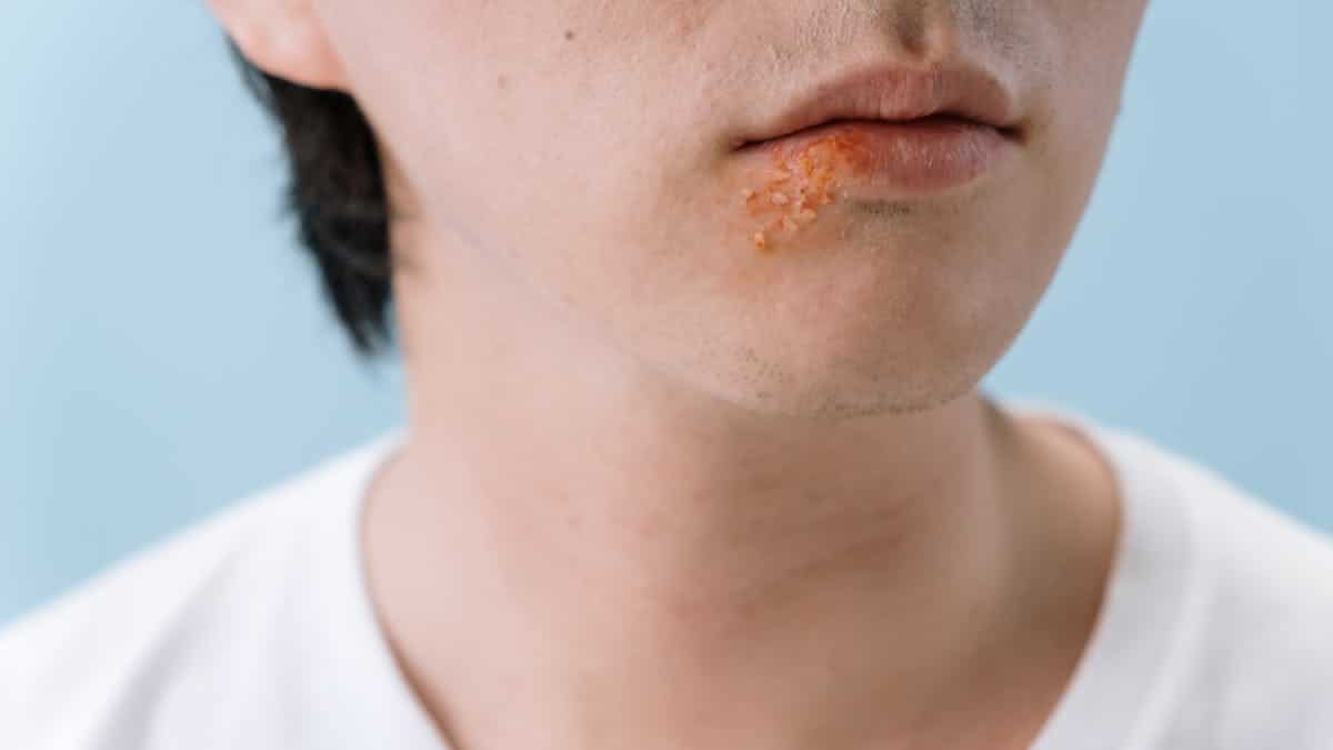 Herpes