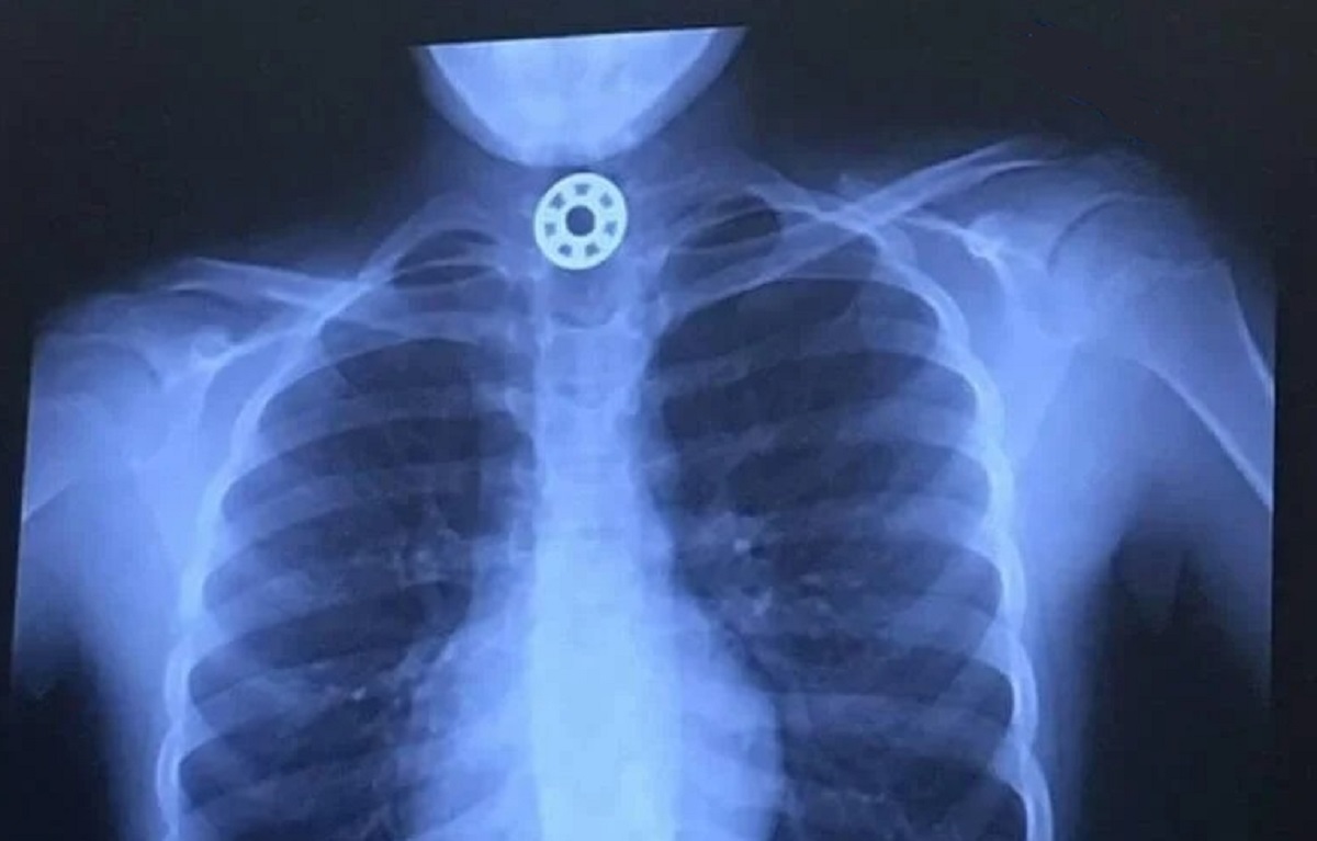 rentgen spolknutý fidget spinner