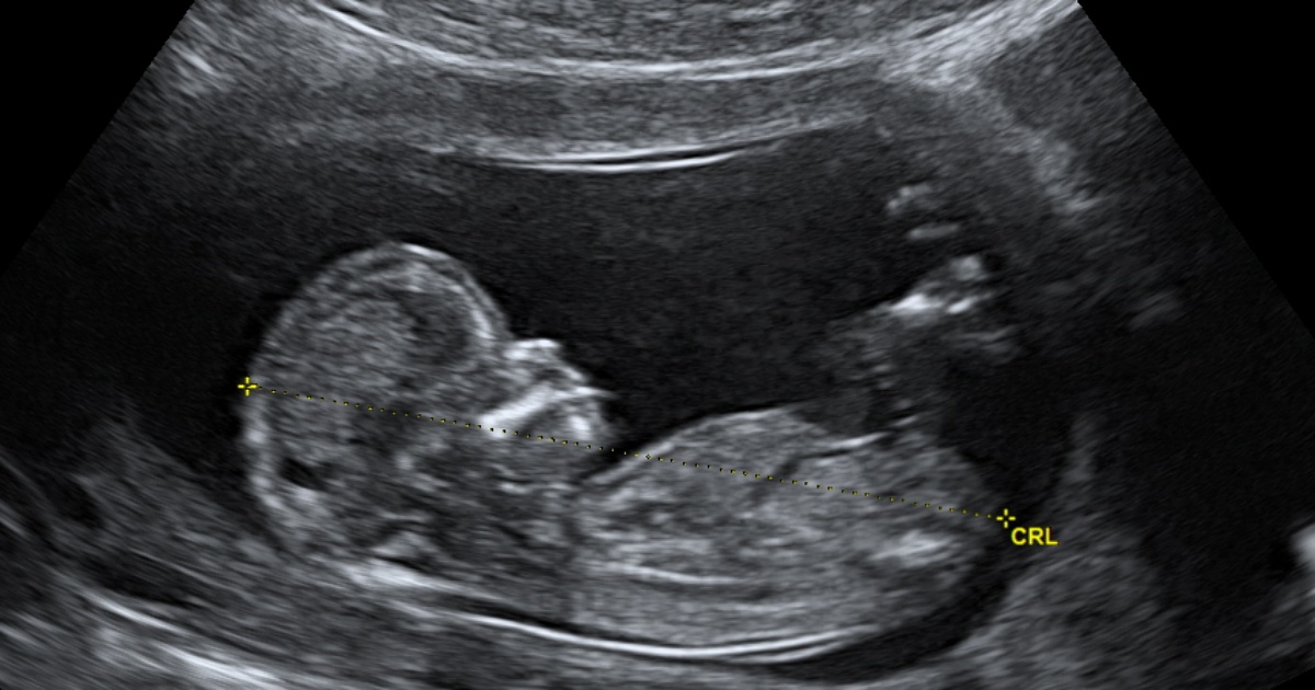 ultrazvuk-tehotenstvi-dite